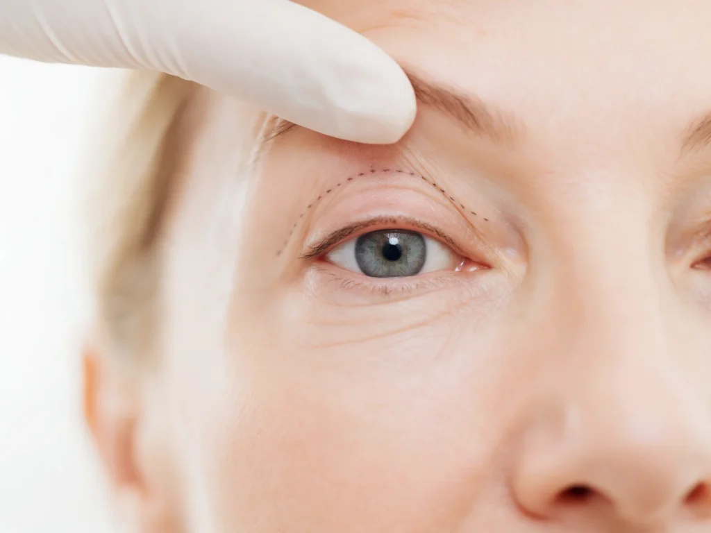 Marcaje del pliegue del párpado superior antes de una blefaroplastia