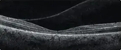 Ilustración de un corte de retina obtenido mediante OCT; no es un resultado diagnóstico.