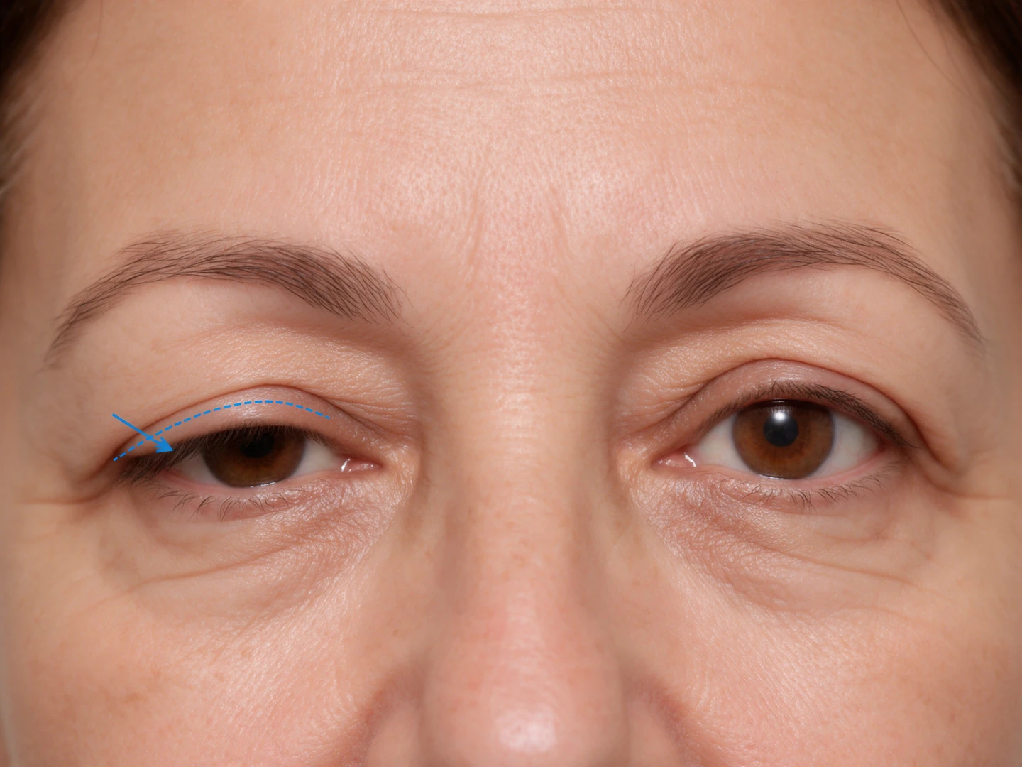 Simulación digital de ptosis palpebral: borde del párpado superior descendido, señalado en azul.